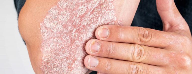 Псориаз или чешуйчатый лишай